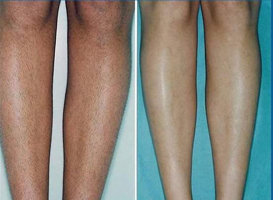 Before and After of a mans legs
