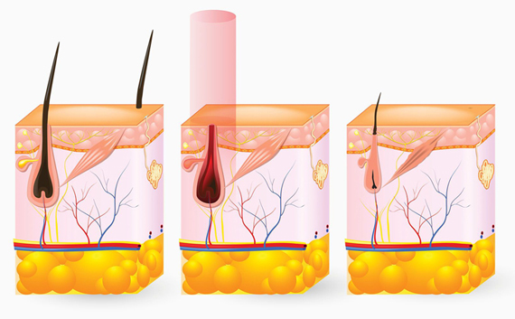 Diagram showing how laser hair removal works