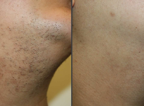 Before and After of face and neck