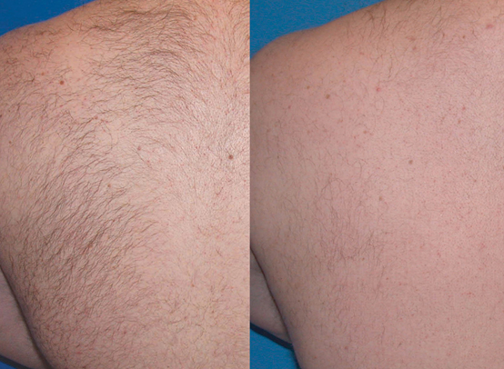 Before and After of a mans upper back