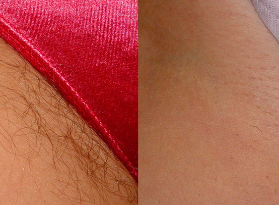 Before and After of a womens bikini area